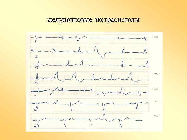 желудочковые экстрасистолы 