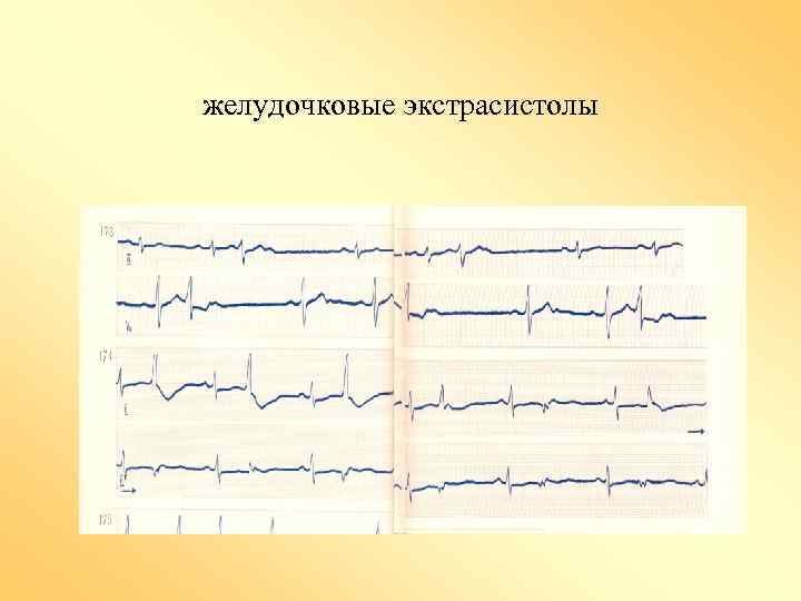 желудочковые экстрасистолы 