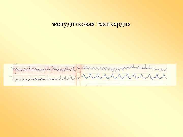 желудочковая тахикардия 