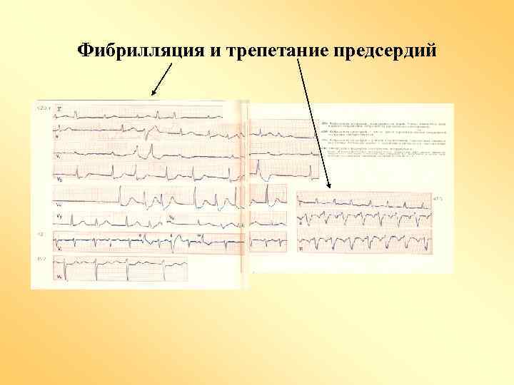 Фибрилляция и трепетание предсердий 