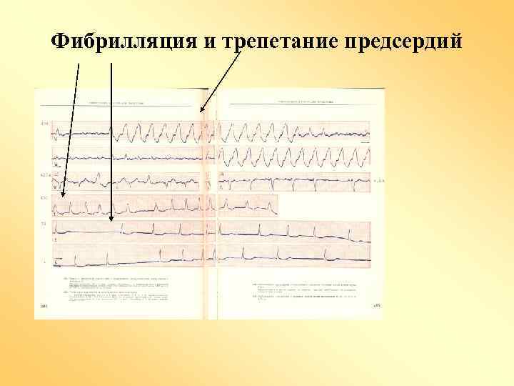 Фибрилляция и трепетание предсердий 