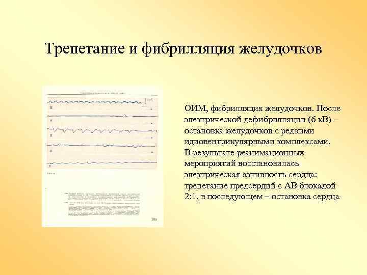 Трепетание и фибрилляция желудочков ОИМ, фибрилляция желудочков. После электрической дефибрилляции (6 к. В) –