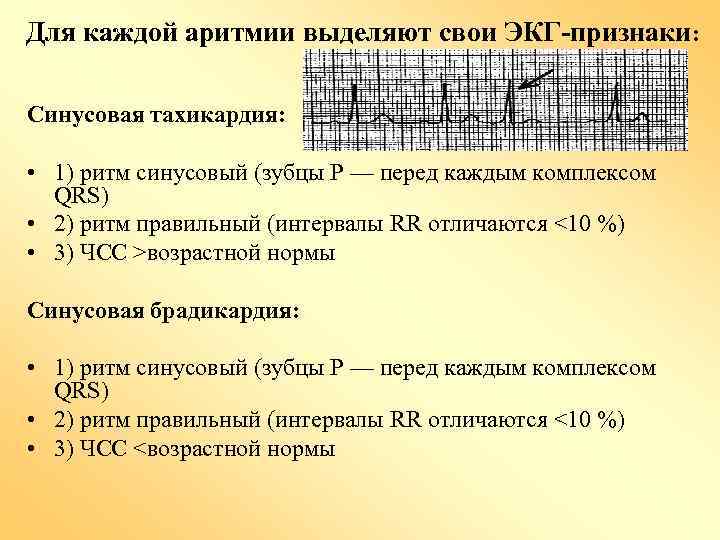 Для каждой аритмии выделяют свои ЭКГ-признаки: Синусовая тахикардия: • 1) ритм синусовый (зубцы P