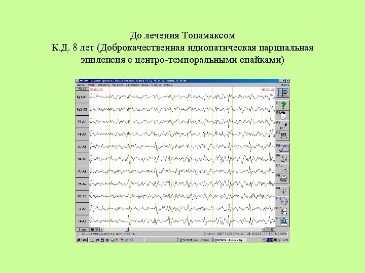 До лечения Топамаксом К. Д. 8 лет (Доброкачественная идиопатическая парциальная эпилепсия с центро-темпоральными спайками)