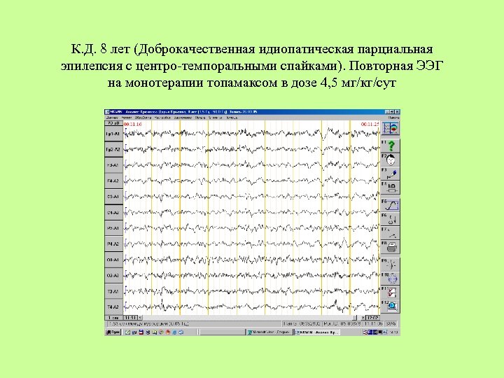 К. Д. 8 лет (Доброкачественная идиопатическая парциальная эпилепсия с центро-темпоральными спайками). Повторная ЭЭГ на