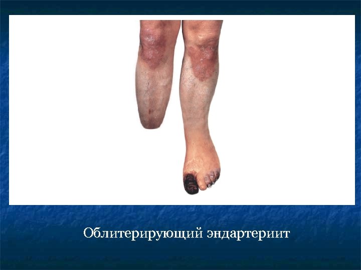 Облитерирующий эндартериит 