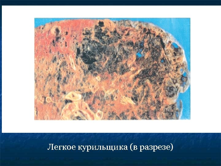 Легкое курильщика (в разрезе) 