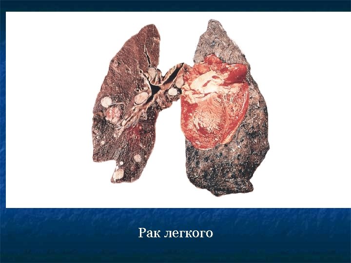 Рак легкого 