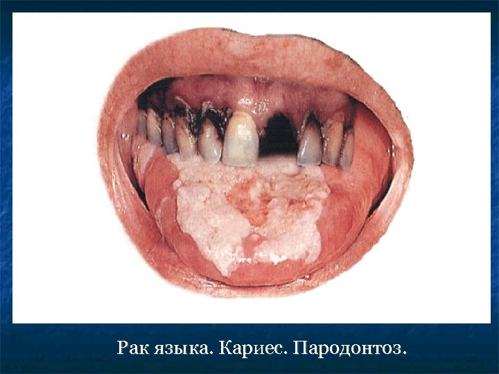 Рак языка. Кариес. Пародонтоз. 