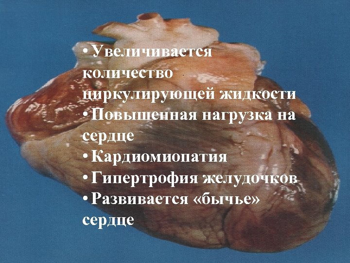  • Увеличивается количество циркулирующей жидкости • Повышенная нагрузка на сердце • Кардиомиопатия •