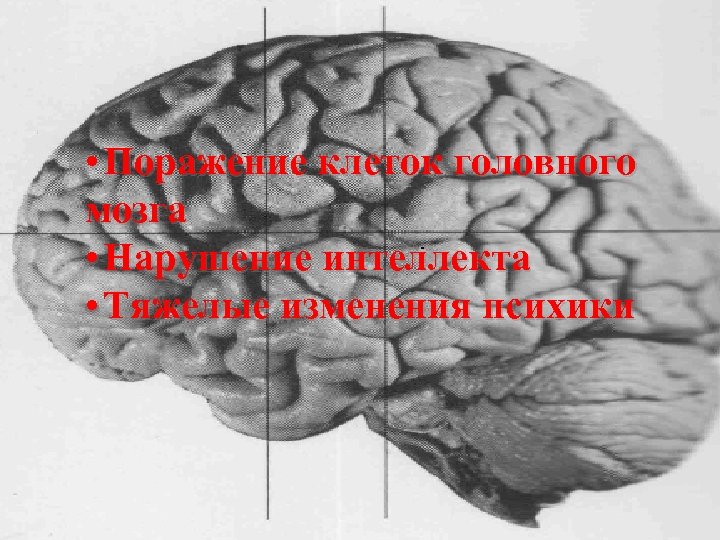  • Поражение клеток головного мозга • Нарушение интеллекта • Тяжелые изменения психики 