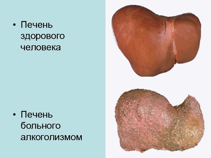  • Печень здорового человека • Печень больного алкоголизмом 