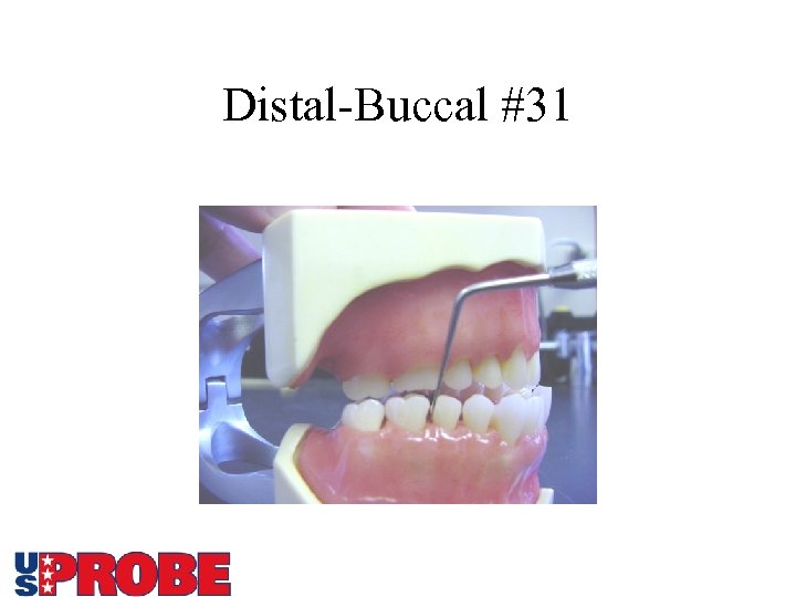 Distal-Buccal #31 