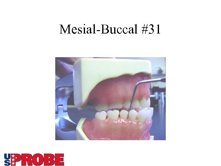 Mesial-Buccal #31 