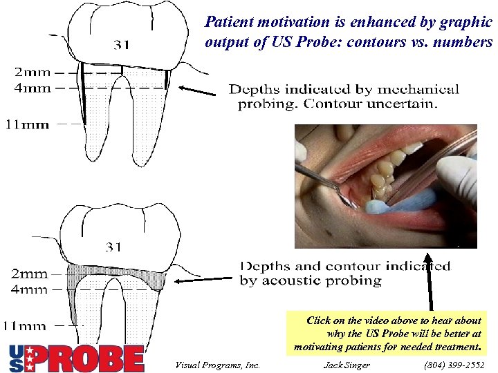 Patient motivation is enhanced by graphic output of US Probe: contours vs. numbers Click