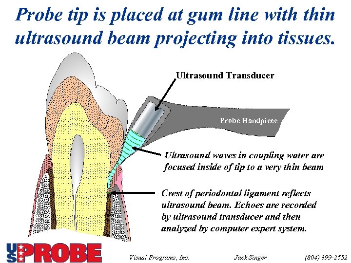 Probe tip is placed at gum line with thin ultrasound beam projecting into tissues.