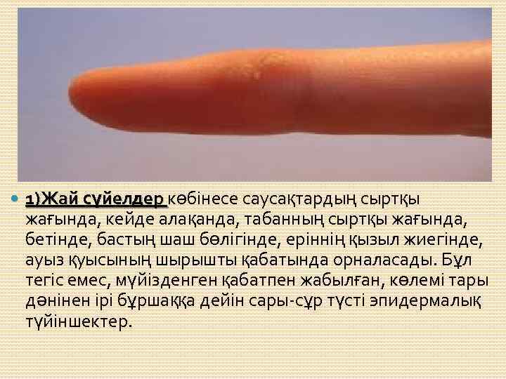  1)Жай сүйелдер көбінесе саусақтардың сыртқы жағында, кейде алақанда, табанның сыртқы жағында, бетінде, бастың