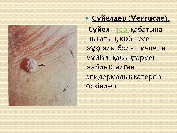  Сүйелдер (Verrucae). Сүйел - тері қабатына шығатын, көбінесе жұқпалы болып келетін мүйізді қабықтармен