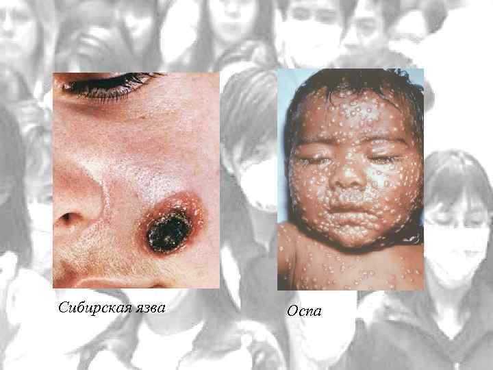Сибирская язва Оспа 