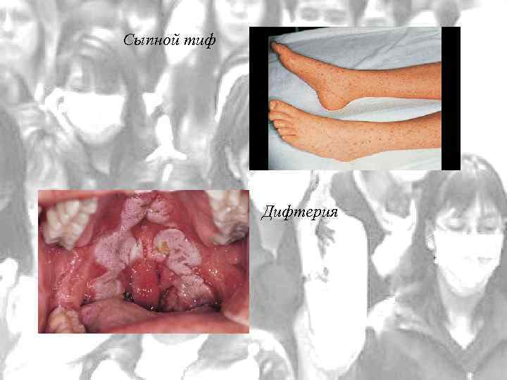 Сыпной тиф Дифтерия 