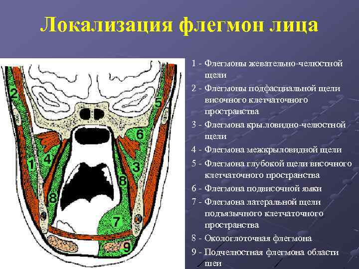 Локализация флегмон лица 1 - Флегмоны жевательно-челюстной щели 2 - Флегмоны подфасциальной щели височного