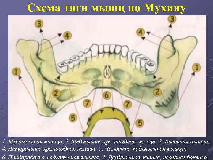 Схема тяги мышц по Мухину 1. Жевательная мышца; 2. Медиальная крыловидная мышца; 3. Височная