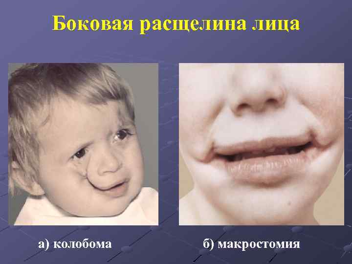 Боковая расщелина лица а) колобома б) макростомия 