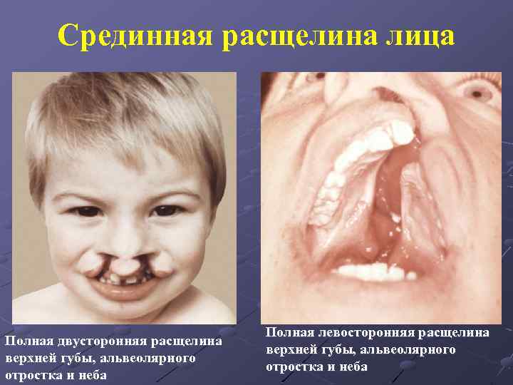Срединная расщелина лица Полная двусторонняя расщелина верхней губы, альвеолярного отростка и неба Полная левосторонняя