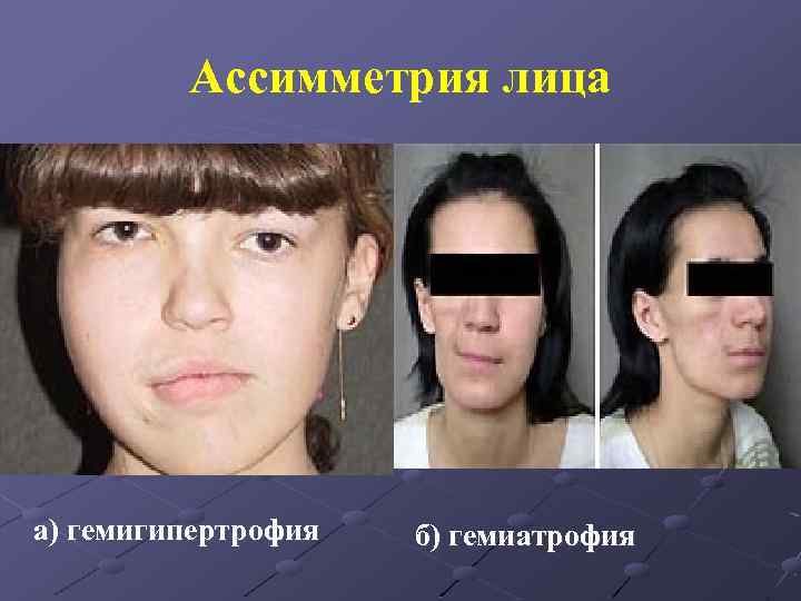 Ассимметрия лица а) гемигипертрофия б) гемиатрофия 