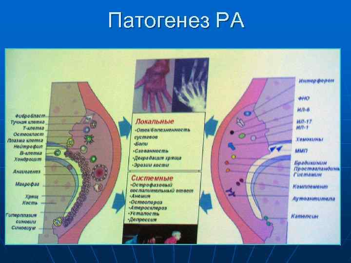 Патогенез РА 