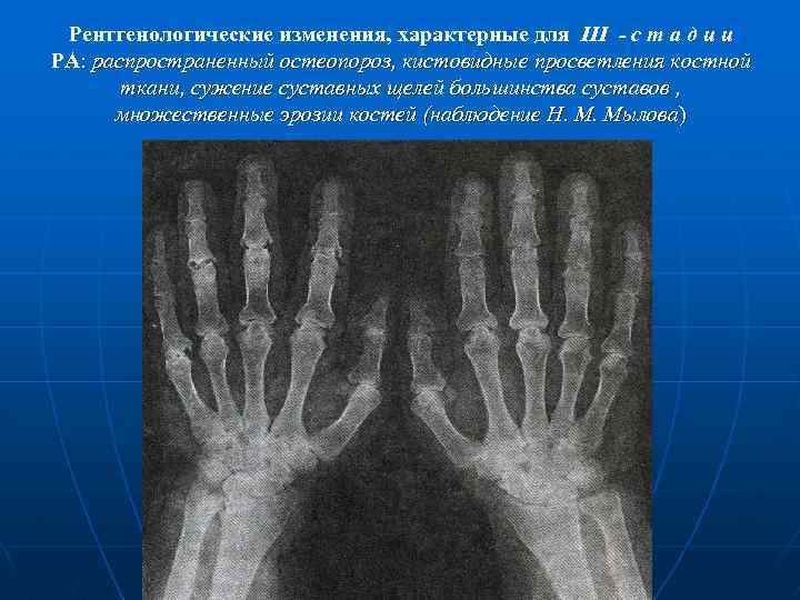 Рентгенологическая картина при ревматоидном артрите