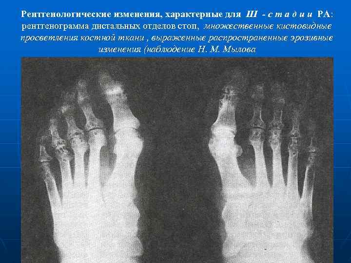 Рентгенологические изменения, характерные для III - с т а д и и РА: рентгенограмма