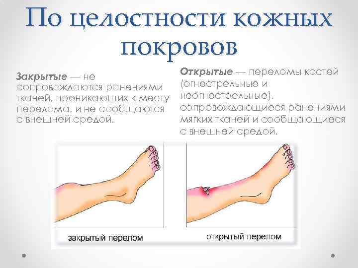 По целостности кожных покровов Закрытые — не сопровождаются ранениями тканей, проникающих к месту перелома,