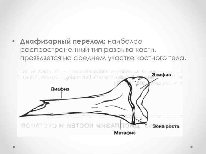  • Диафизарный перелом: наиболее распространенный тип разрыва кости, проявляется на среднем участке костного