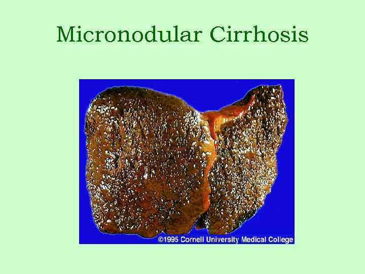 Micronodular Cirrhosis 