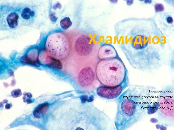 Хламидиоз Подготовила: студентка 5 курса 22 группы лечебного факультета Овчинникова А. Д. 