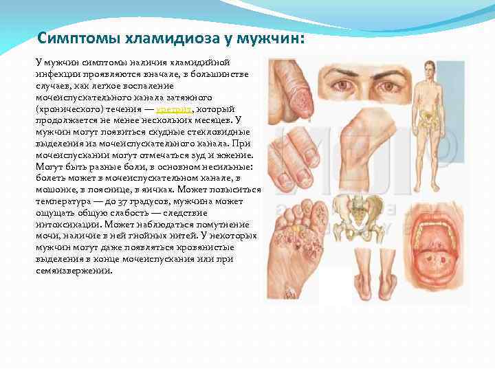 Симптомы хламидиоза у мужчин: У мужчин симптомы наличия хламидийной инфекции проявляются вначале, в большинстве