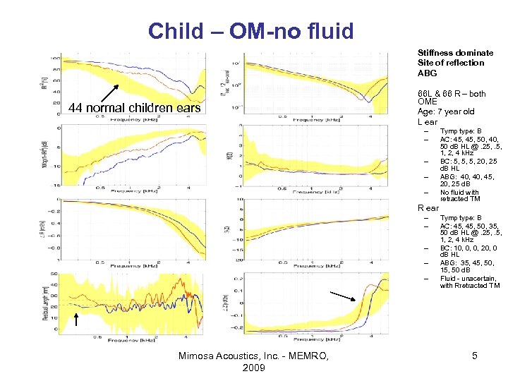Child – OM-no fluid • • 44 normal children ears Stiffness dominate Site of