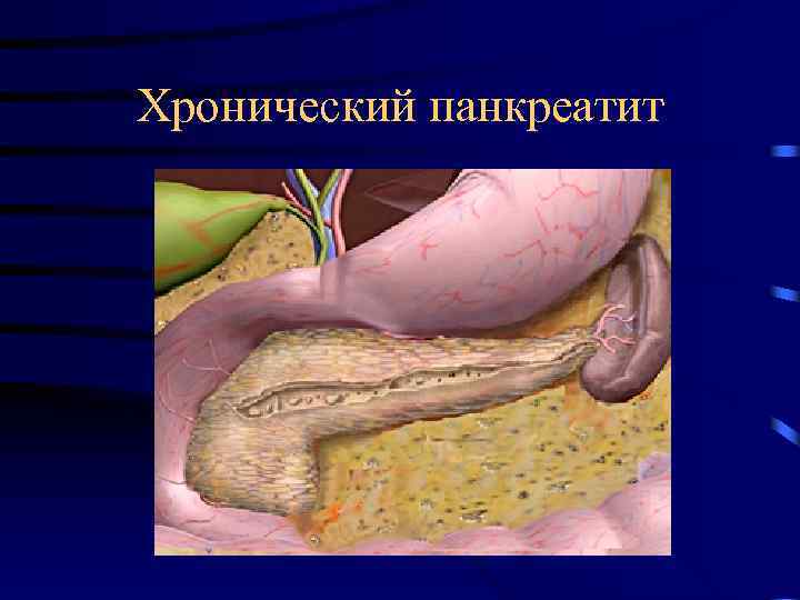 Хронический панкреатит 