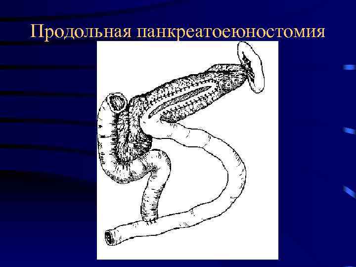 Продольная панкреатоеюностомия 