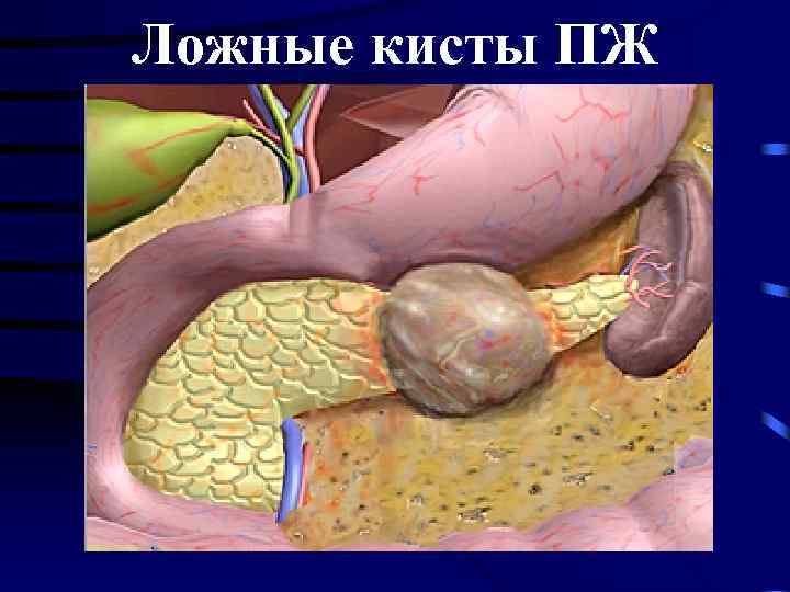 Ложные кисты ПЖ 