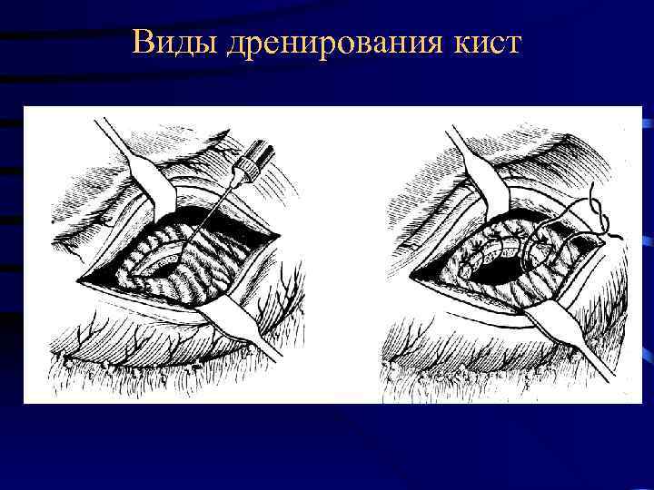 Виды дренирования кист 