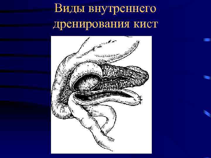 Виды внутреннего дренирования кист 