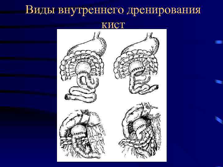Виды внутреннего дренирования кист 