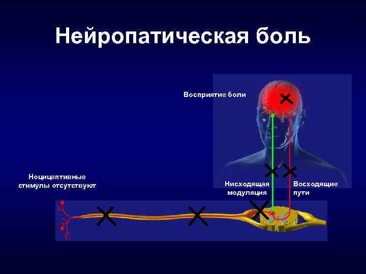 Нейропатическая боль Восприятие боли Ноцицептивные стимулы отсутствуют Нисходящая модуляция Восходящие пути 