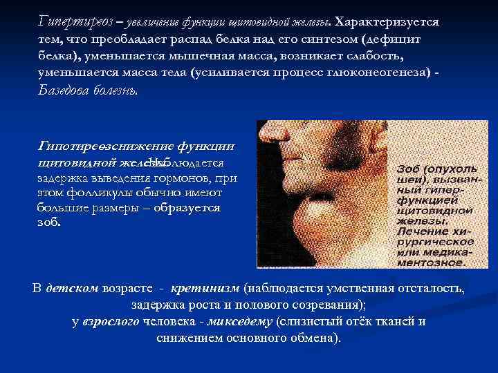 Гипертиреоз – увеличение функции щитовидной железы. Характеризуется тем, что преобладает распад белка над его