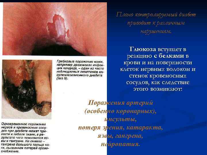 Плохо контролируемый диабет приводит к различным нарушениям. Глюкоза вступает в реакцию с белками в