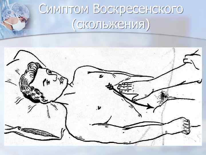 Симптом Воскресенского (скольжения) 