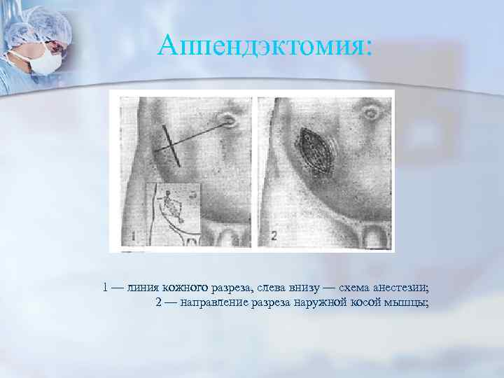 Аппендэктомия: 1 — линия кожного разреза, слева внизу — схема анестезии; 2 — направление