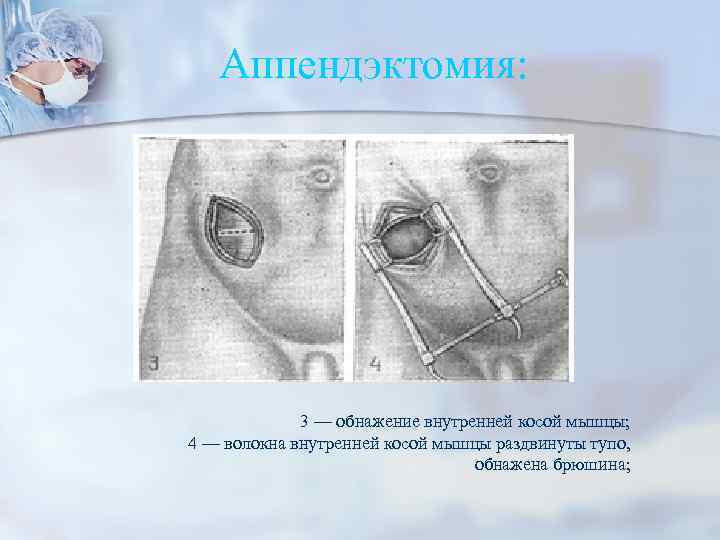 Аппендэктомия: 3 — обнажение внутренней косой мышцы; 4 — волокна внутренней косой мышцы раздвинуты